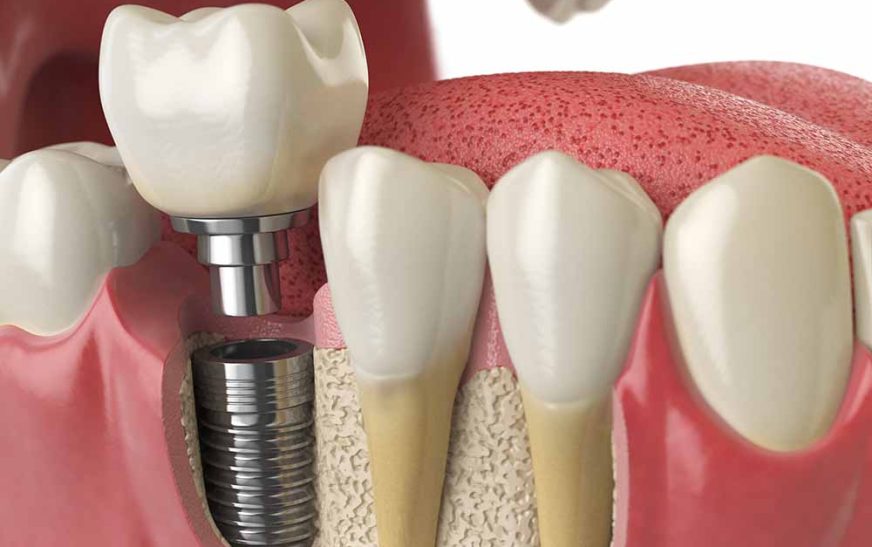 $399 Dental Implants