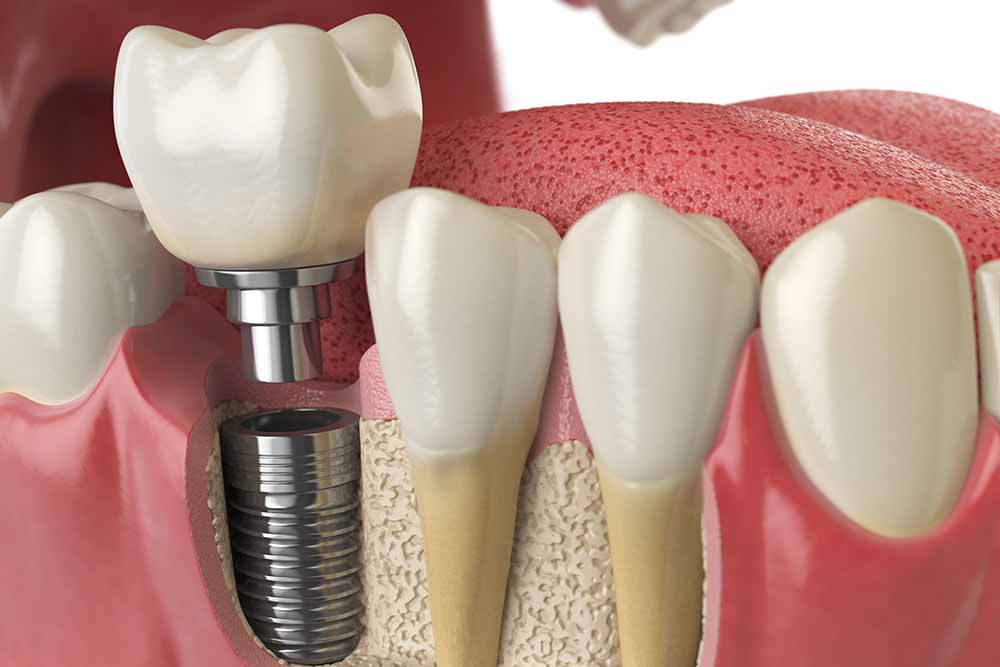 $399 Dental Implants: What You Need to Know Before You Decide